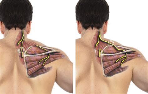 It could have been there for longer but probably not. . How to fix dorsal scapular nerve entrapment